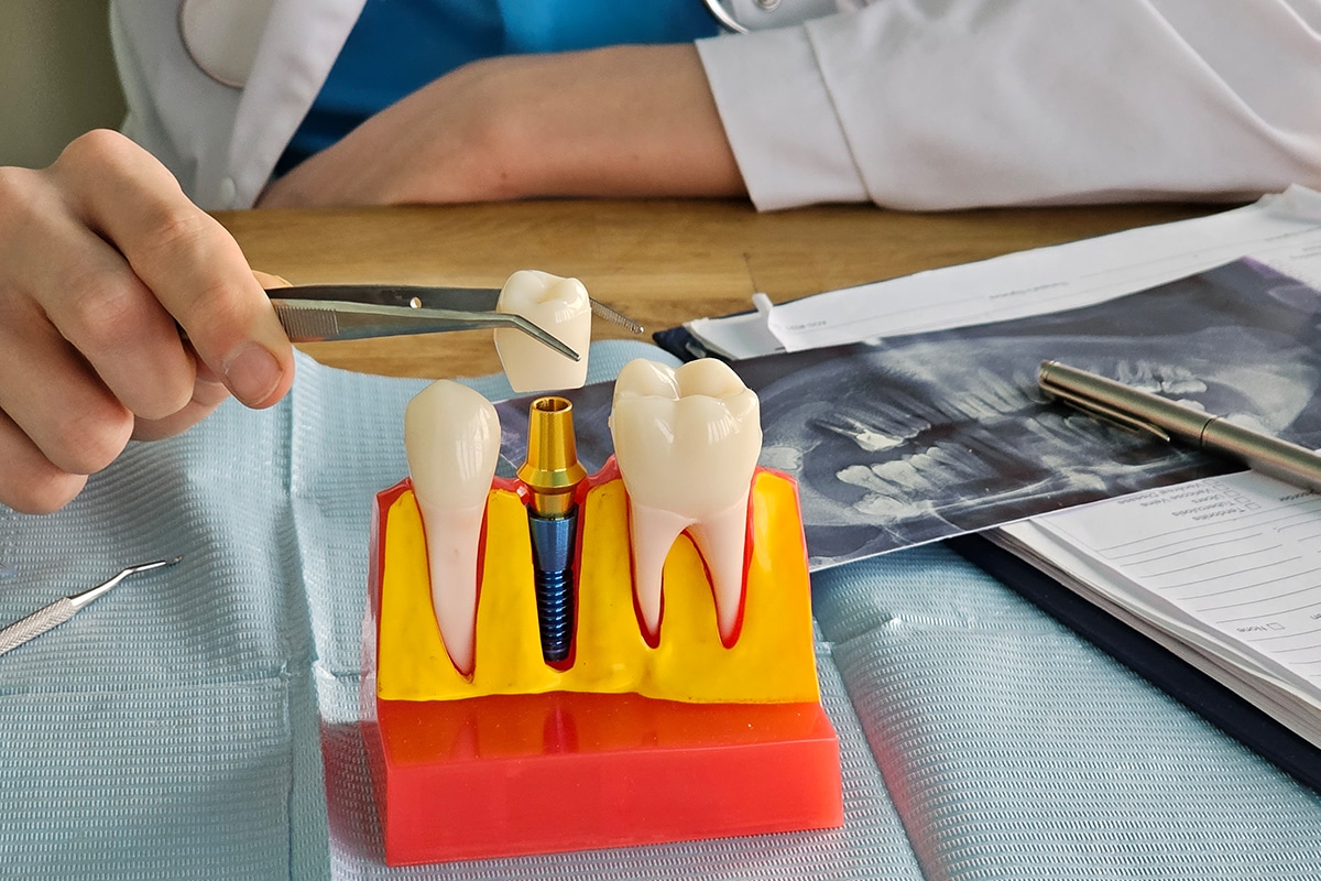 How much do dental implants cost in waimea hi blog